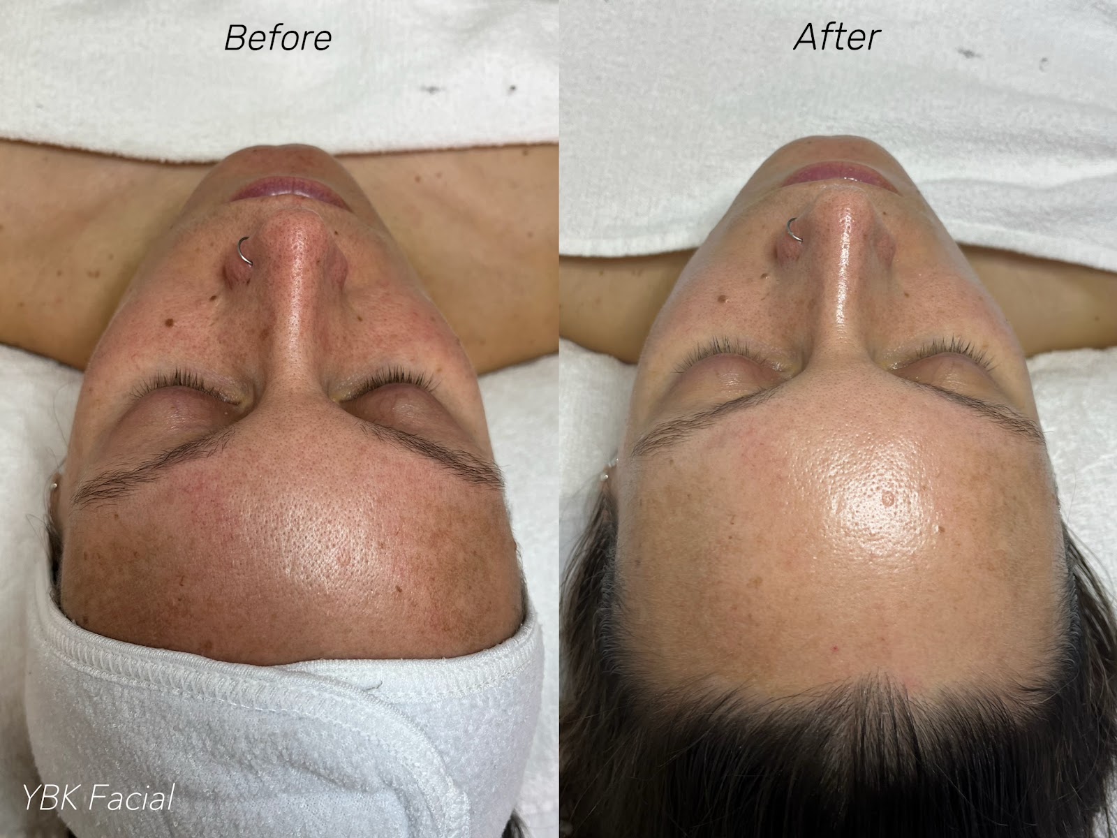 YBK Facial before and after