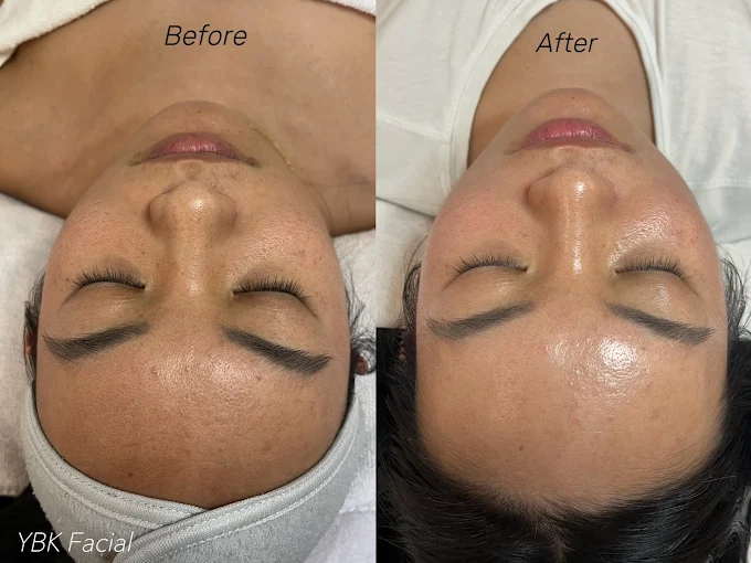 YBK Facial before and after