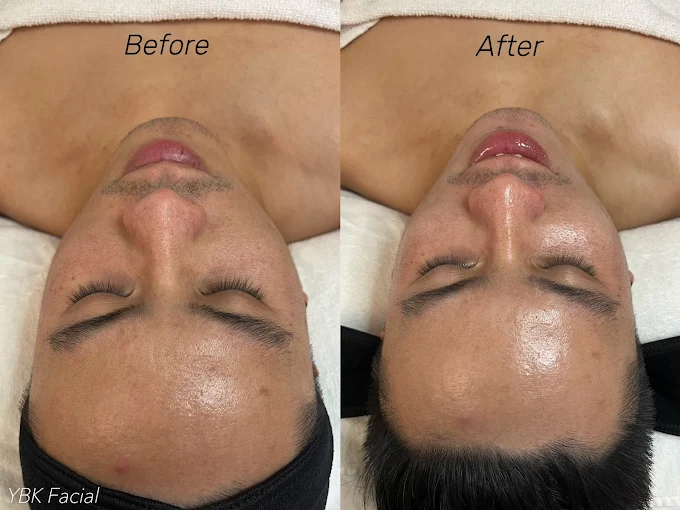 YBK Facial before and after